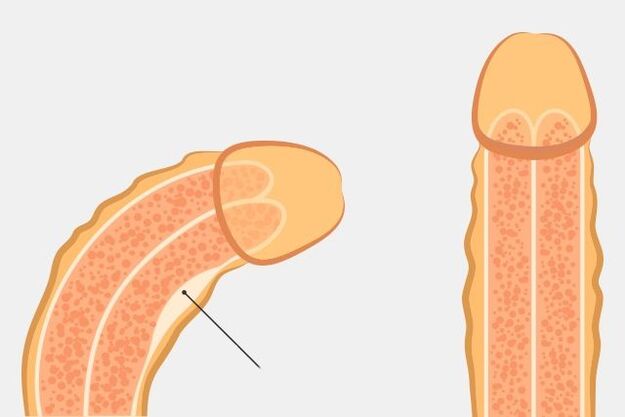 forma efectiva de enderezar el pene