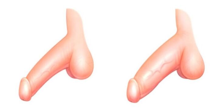 pene antes y después del agrandamiento